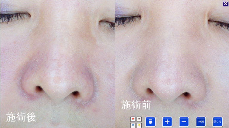 美容鍼症例：鼻のむくみ